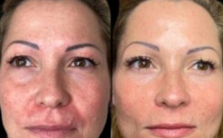 Refresh Naturally with Profhilo from Best Doctors in Dubai