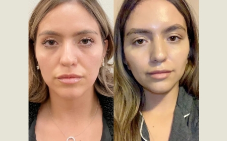 Top Clinics and Best Doctors in Dubai for Thread Lift: The Key to a Younger, Lifted Appearance