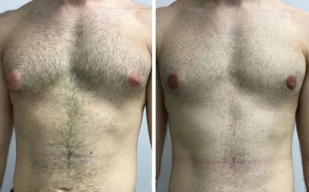 Questions to Ask During Your Consultation with the Best Gynecomastia Surgeons in Dubai