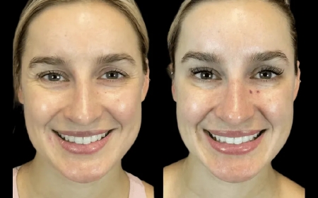 Why Expats Choose the Best Plastic Surgeon in dubai for Botox