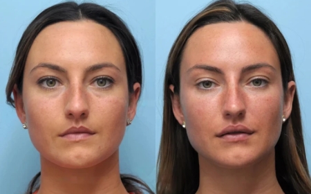 Best Plastic Surgeon in Dubai for Thread Lift Results That Look Natural