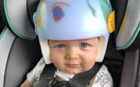 Plagiocephaly Treatment in New York | Expert Pediatric Care