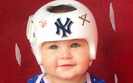 Custom Infant Helmet Therapy in New York for Head Shaping