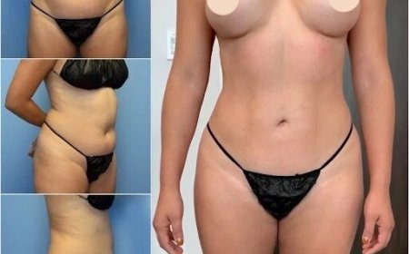 Achieve a Sculpted Physique with Body Contouring in Dubai