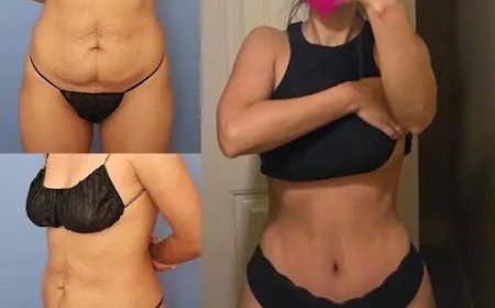 Tummy Tuck in Dubai: Find the Best Surgeons for Your Desired Results