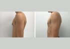 Top Tips for Choosing the Best Gynecomastia Surgeon in Dubai for Your Consultation