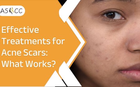 Effective Treatments for Acne Scars: What Works?