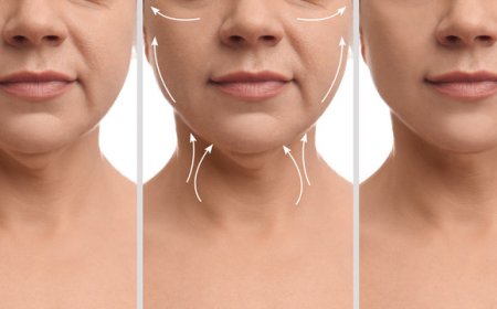 Rediscover Your Youth: Non-Surgical Neck Lift in Beverly Hills