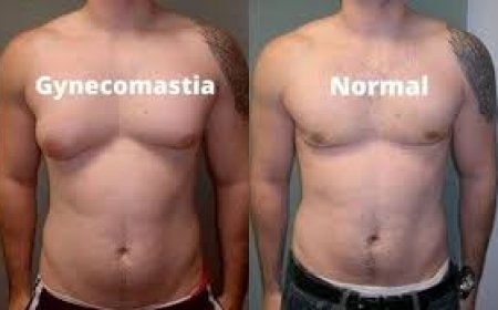 Is Male Breast Reduction in Islamabad Right for You? Expert Advice
