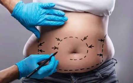 Who Should Consider Liposuction Islamabad? A Medical Perspective
