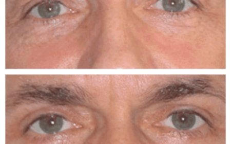 Eye Bag Removal Surgery in Dubai: What to Expect Before and After
