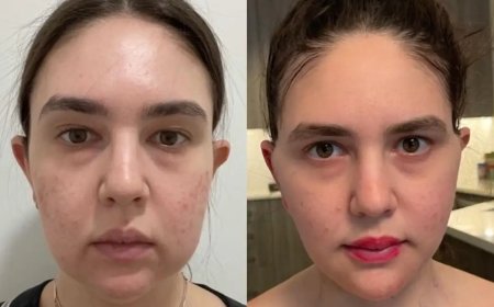 Buccal fat removal Surgery in Dubai: Lifestyle Changes Post-Op