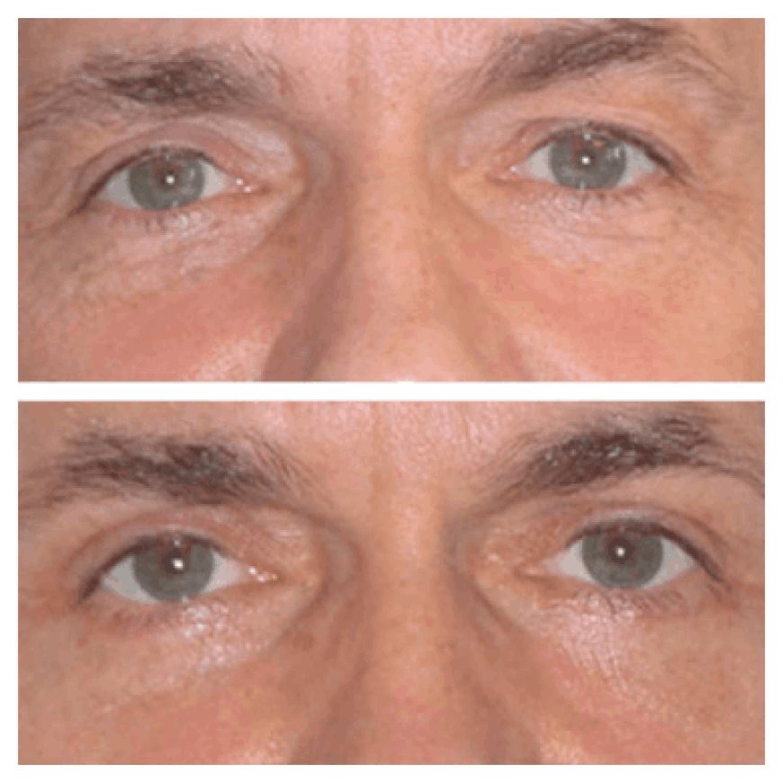 Eye Bag Removal Surgery in Dubai: What to Expect Before and After